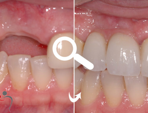 Bridge to restore missing teeth