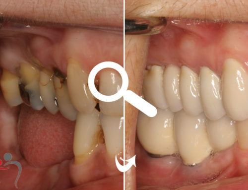 Full Mouth Reconstruction