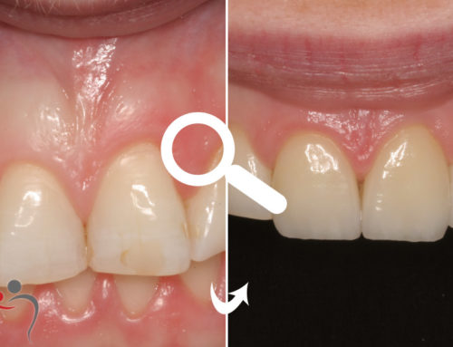 Veneers for Front Teeth